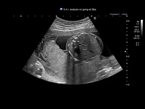 Imagistica Superb Micro-vascular Imaging (SMI) evidențiază fluxul sanguin cu viteză redusă în rinichi.