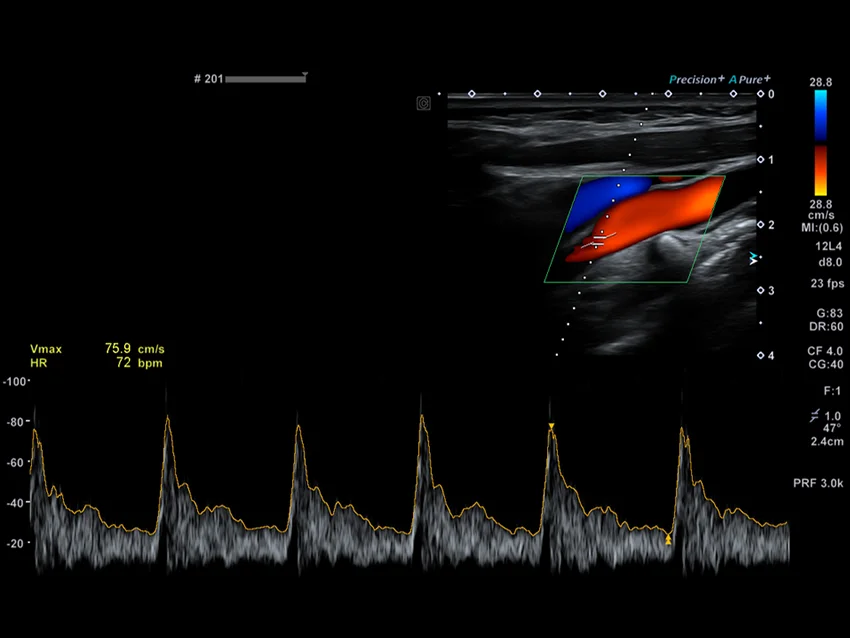 Imagistica de Atenuare (Attenuation Imaging - ATI) poate sprijini analiza steatozei hepatice prin vizualizarea atenuării ultrasunetelor în ficat.