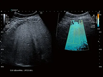 Shear Wave Dispersion (SWD) adaugă informații suplimentare în evaluarea steatozei.