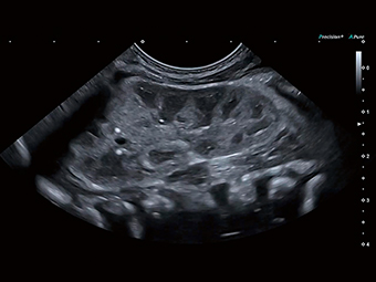 La nou-născuți, anatomia majoră poate fi observată cu o singură sondă.