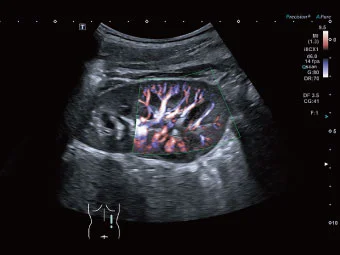 La nou-născuți, anatomia majoră poate fi observată cu o singură sondă.