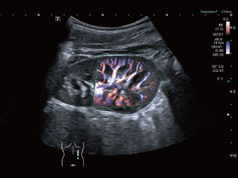 Delinierea clară a vaselor în rinichi pediatric folosind Advanced Dynamic Flow (ADF).