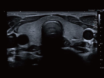 Tiroidă normală: avantajele frecvenței înalte și tehnologiilor Precision/ApliPure.