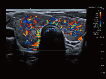 Doppler color foarte sensibil oferind informații precise despre statusul vascular tiroidian.