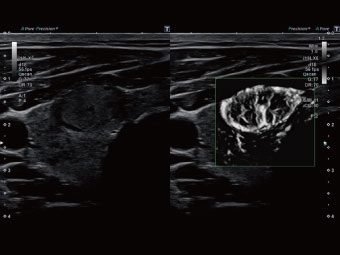 SMI în modul mSMI relevă detalii bogate despre vascularizația acestui nodul tiroidian.