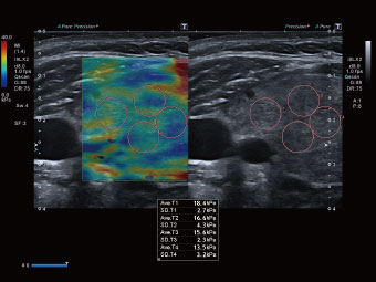 Elastografia de strain, o tehnică simplă pentru informații clinice suplimentare.