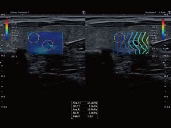 Elastografia Shear Wave cu mapare și cuantificare oferă informații clinice cheie.