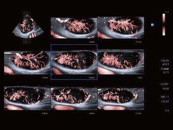 Sensor 3D cu cSMI vizualizează acest ganglion limfatic inflamator benign în secțiuni submilimetrice.