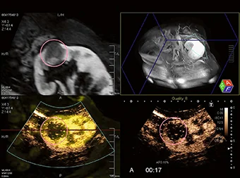 Fuziunea ecografică cu CT sau RMN oferă informații diagnostice combinate.