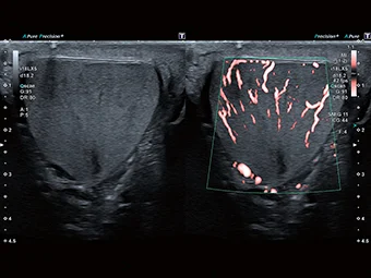Maparea fluxului de înaltă rezoluție cu SMI permite rezultate diagnostice optime.