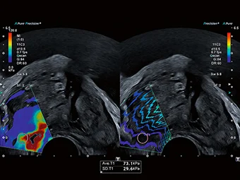Elastografia sau imagistica de perfuzie cresc încrederea diagnostică.