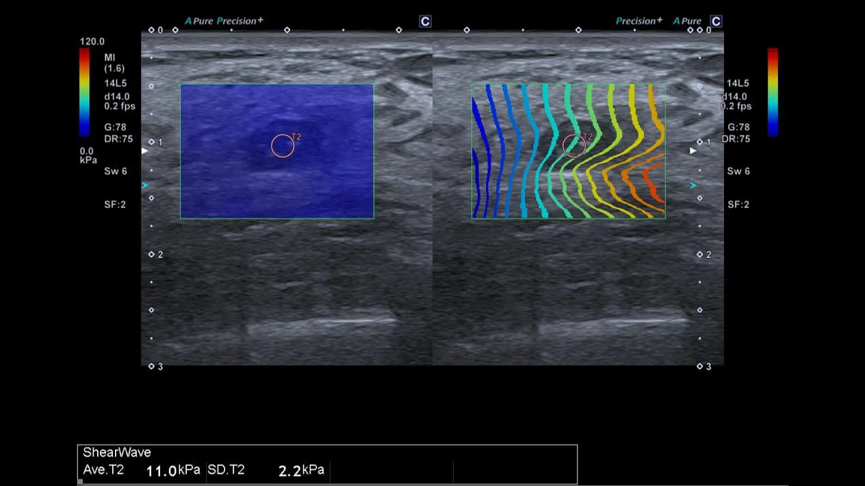 Elastografia Shear Wave (SWE) arată diferența în acest fibroadenom mamar comparativ cu țesutul înconjurător.