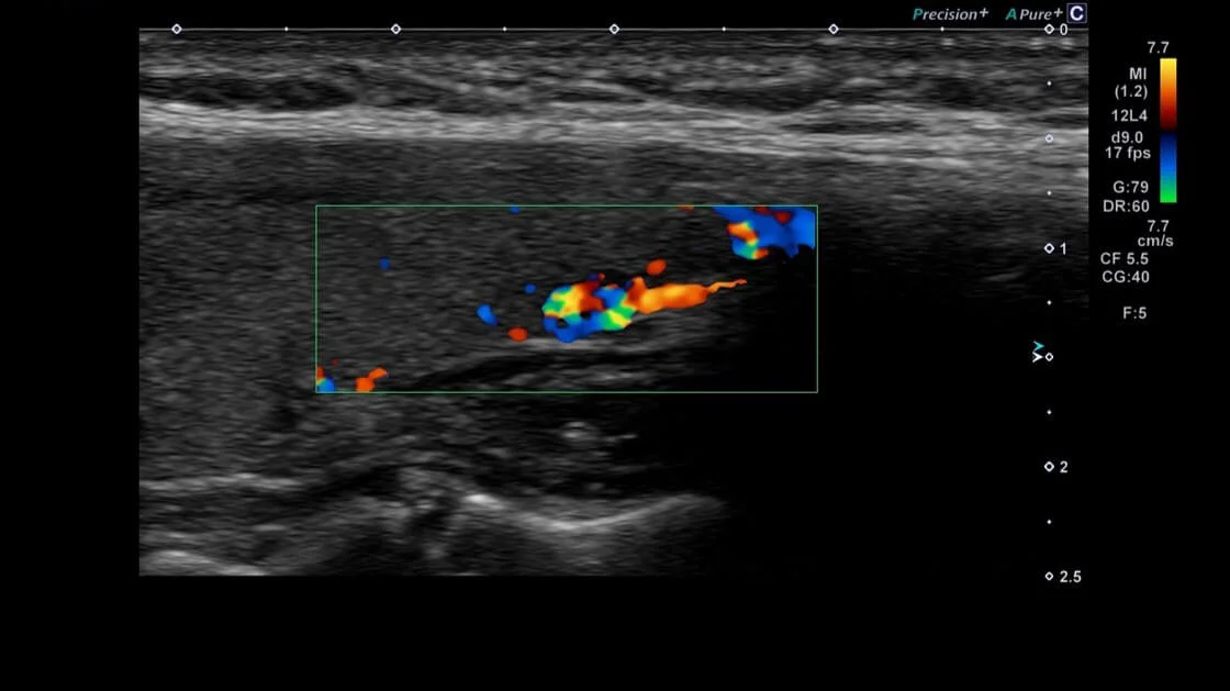 Imagistica Color Doppler (CDI) arătând vascularitatea în interiorul și în jurul leziunii tiroidiene.
