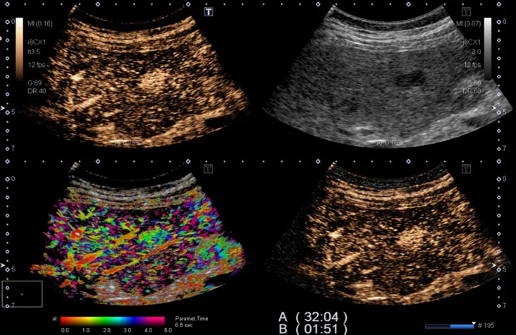 Contrast Harmonic Imaging