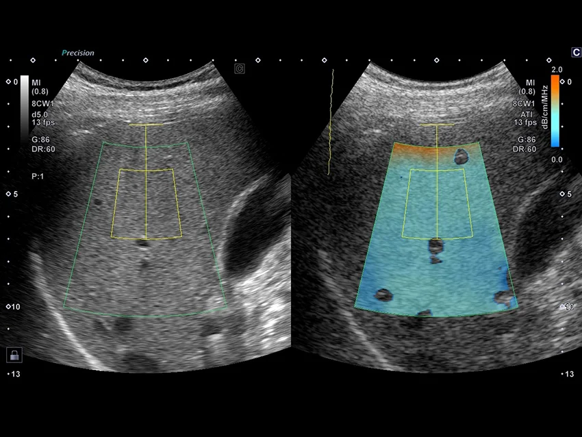Imagistica de Atenuare (Attenuation Imaging - ATI) poate sprijini analiza steatozei hepatice prin vizualizarea atenuării ultrasunetelor în ficat.