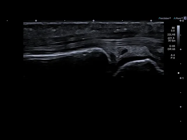 Imagistica de Atenuare (Attenuation Imaging - ATI) poate sprijini analiza steatozei hepatice prin vizualizarea atenuării ultrasunetelor în ficat.