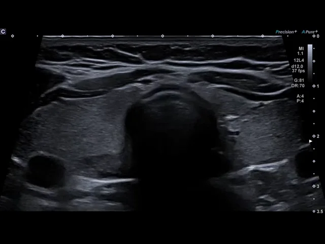 Imagistica de Atenuare (Attenuation Imaging - ATI) poate sprijini analiza steatozei hepatice prin vizualizarea atenuării ultrasunetelor în ficat.
