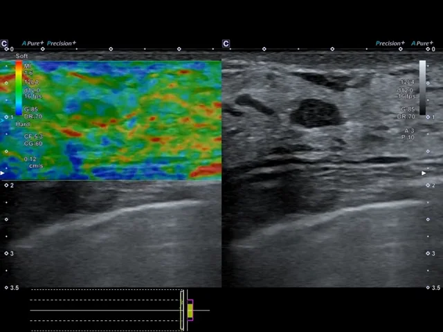 Imagistica de Atenuare (Attenuation Imaging - ATI) poate sprijini analiza steatozei hepatice prin vizualizarea atenuării ultrasunetelor în ficat.