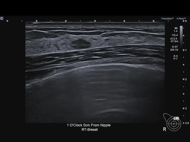Imagistica de Atenuare (Attenuation Imaging - ATI) poate sprijini analiza steatozei hepatice prin vizualizarea atenuării ultrasunetelor în ficat.