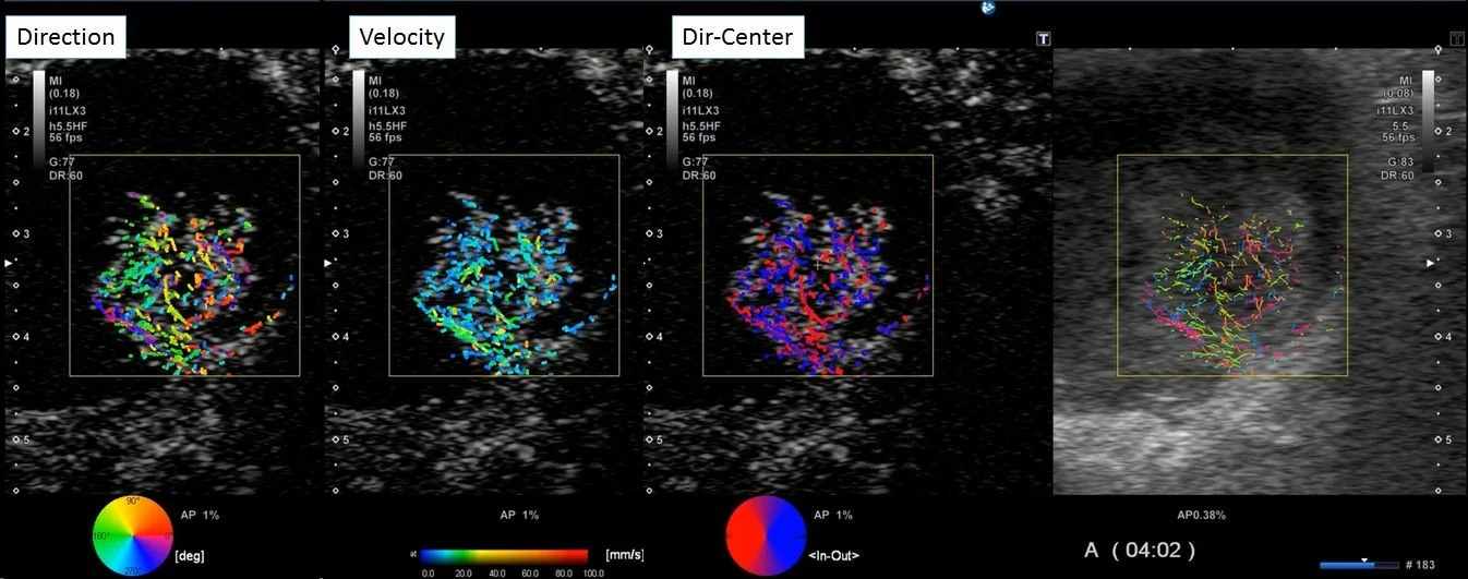 Contrast Vector Imaging pentru o leziune a vezicii biliare