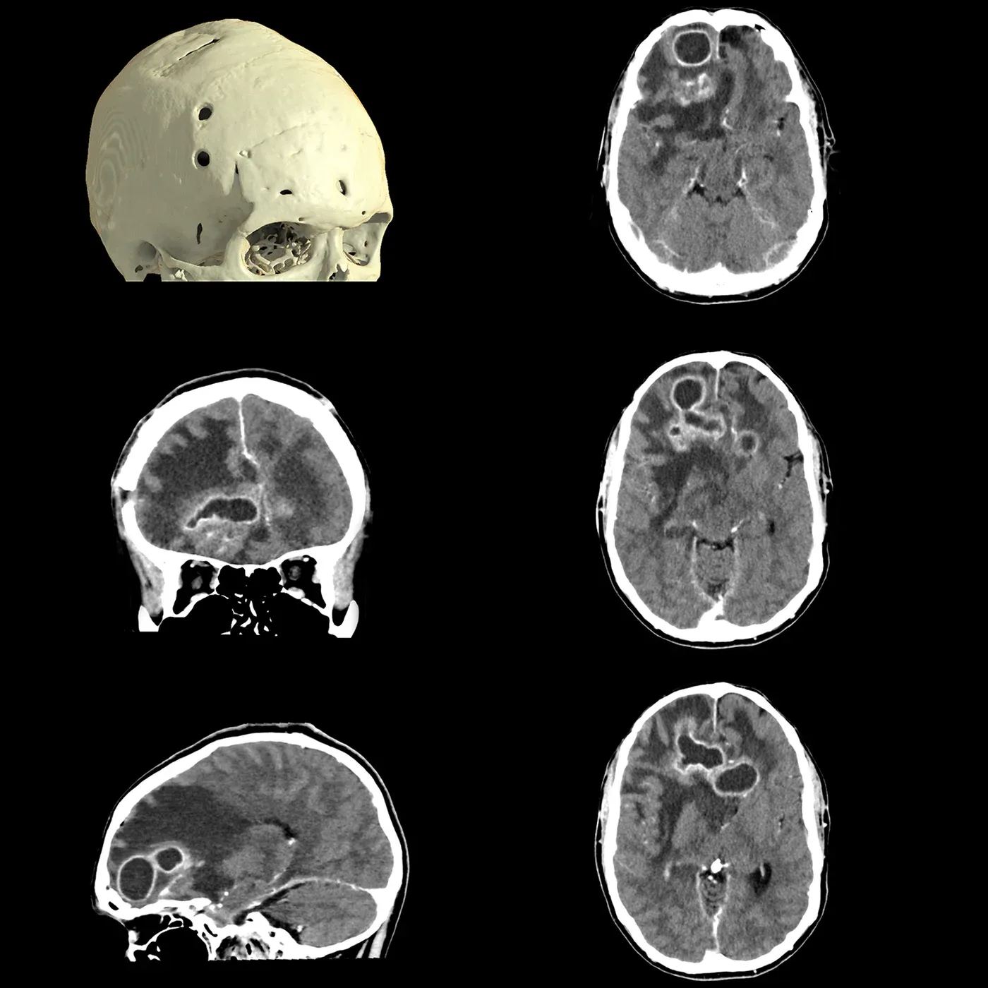 Abcese cerebrale, AiCE – Detectabilitatea îmbunătățită a leziunilor cu contrast redus prin AiCE DLR evidențiază multiple leziuni chistice loculate în ambele emisfere cerebrale, cu priză de contrast periferică și modificări edematoase consecutive ale parenchimului cerebral.