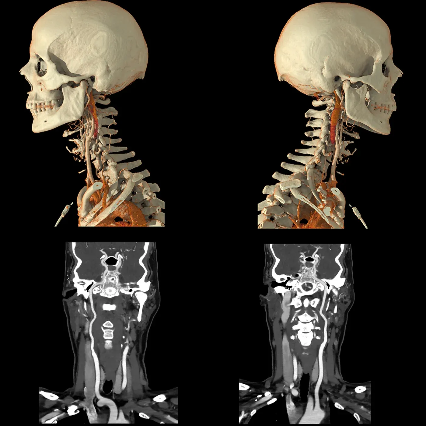 Angio-CT carotidiană, AiCE – Angio-CT Ultra Helical cu doză redusă a arterelor carotide și a poligonului Willis, în bilanțul unui accident vascular cerebral. AiCE DLR asigură o vizualizare clară a vaselor cu priză de contrast și a țesuturilor moi adiacente, pentru excluderea rapidă și sigură a unei ocluzii.