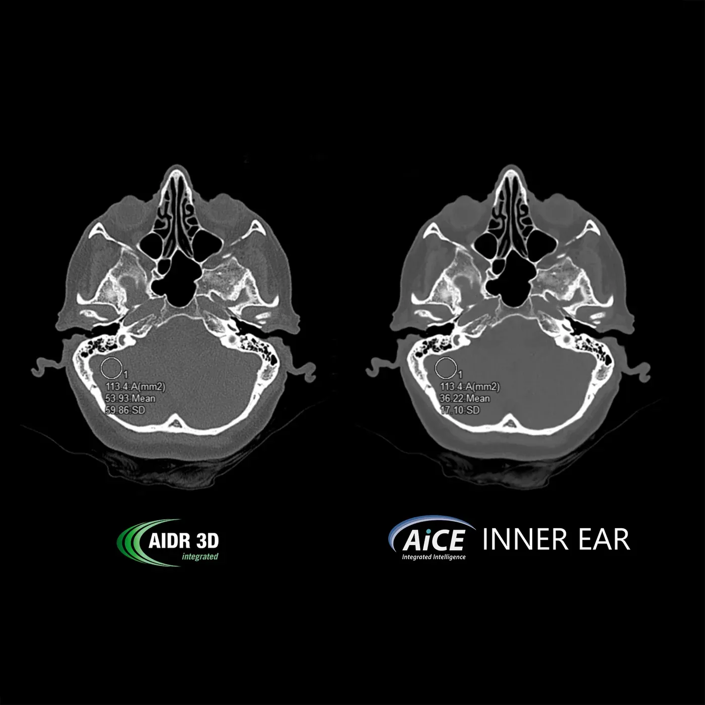 CAI, AiCE – AiCE DLR asigură o încredere diagnostică ridicată în evaluarea structurilor osoase mici din conductul auditiv intern (CAI), printr-o reducere semnificativă a zgomotului, cu menținerea rezoluției înalte.