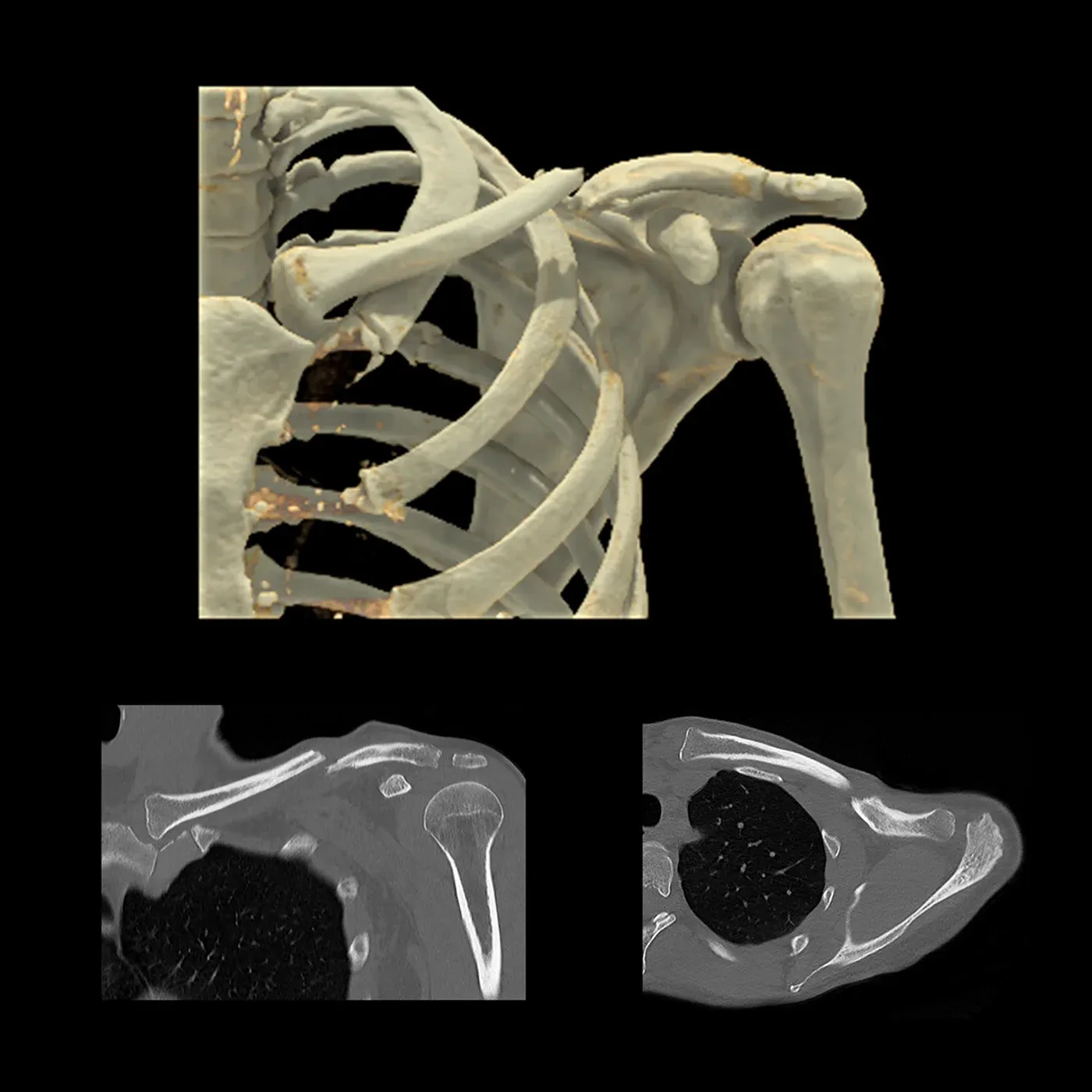 Fractură neconsolidată de claviculă, AiCE – CT volumetric al claviculei stângi, care evidențiază fractura. Zgomotul redus și rezoluția înaltă ale reconstrucției prin deep learning AiCE redau clar clavicula și structurile osoase adiacente, în vederea planificării preoperatorii a fixării la nivelul zonei afectate.