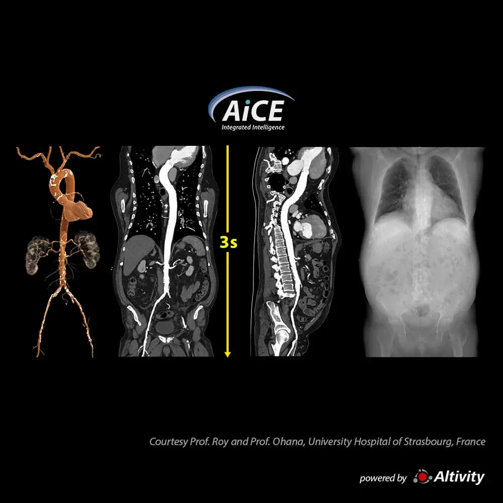 Angio-CT aortă – Turbo Helical – Această achiziție angio-CT ultrarapidă se realizează în 3 s. Întreaga aortă este vizualizată clar, fără artefacte de mișcare.