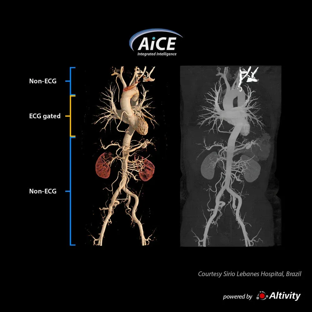 Angio-CT aortă cu vHP – Variable Helical Parameters (vHP) permite, într-o singură achiziție, cu o singură injecție de contrast și într-o singură apnee, un examen al inimii cu sincronizare ECG și un examen fără sincronizare al restului aortei.