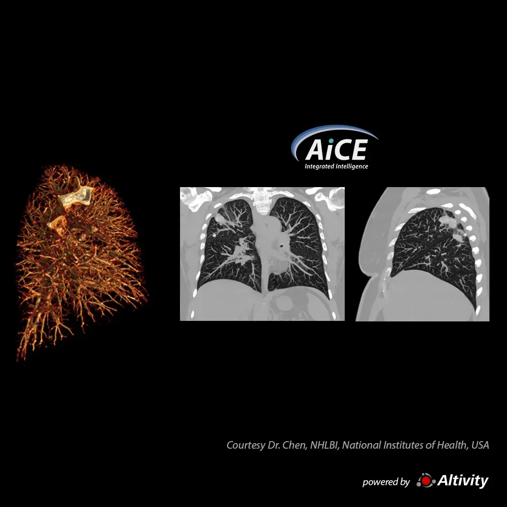 Infecție pulmonară cu Cryptococcus – Imagini GIR excelente cu PIQE 1024 și detalii pulmonare excelente cu AiCE lung, evidențiind infecția pulmonară.