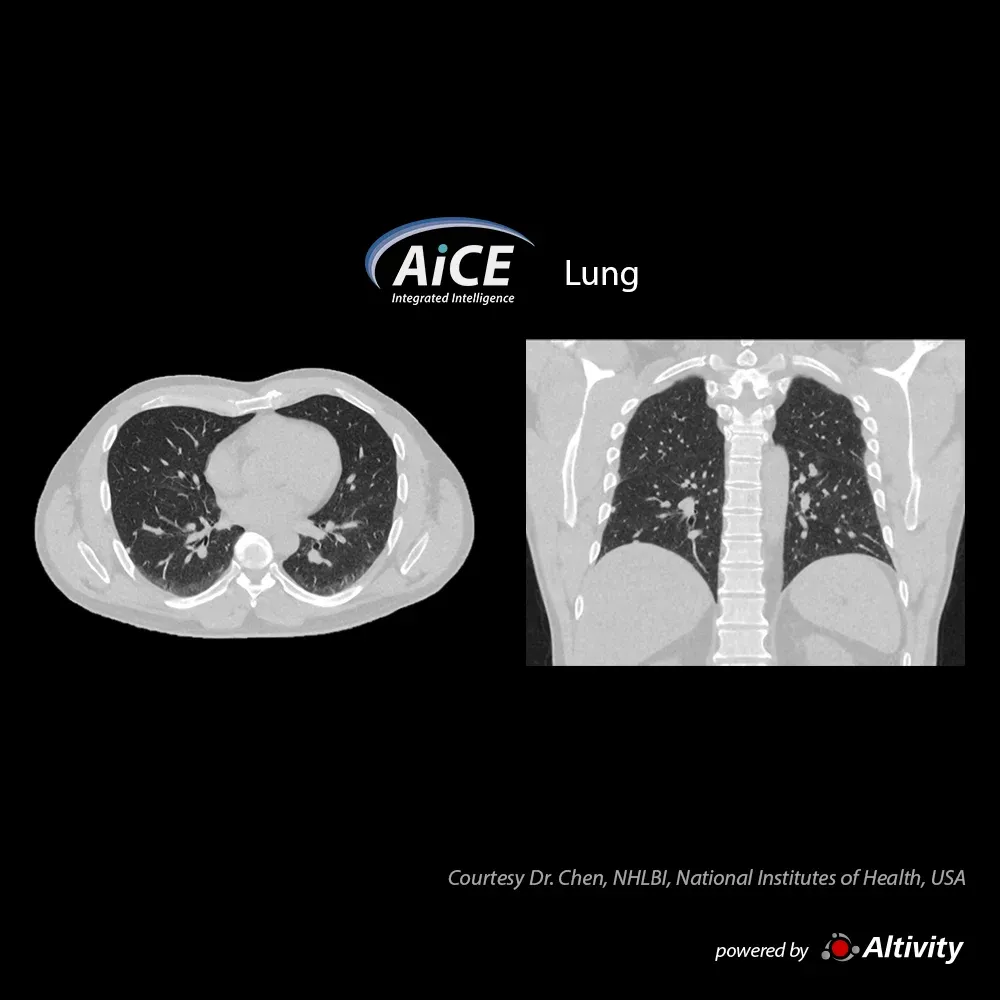 Torace SilverBeam la 0,3 mSv – Un nodul pulmonar este vizibil în această achiziție toracică cu doză redusă, efectuată pentru urmărirea în cadrul screeningului.