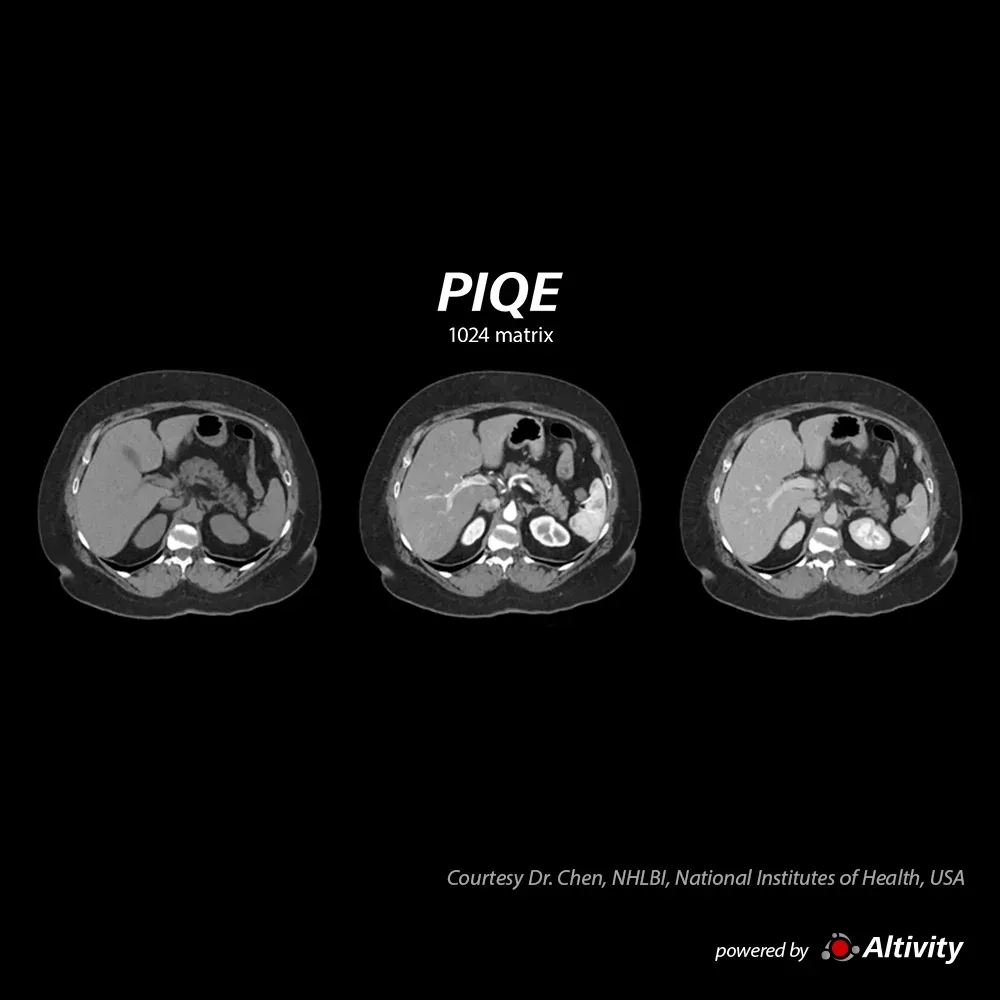 Abdomen multifazic, IMC 40 – Pacientă de 40 de ani, cu IMC 40, la care s-a efectuat un examen hepatic în 3 faze, reconstruit cu PIQE 1024, pentru controlul unei tumori metastatice.