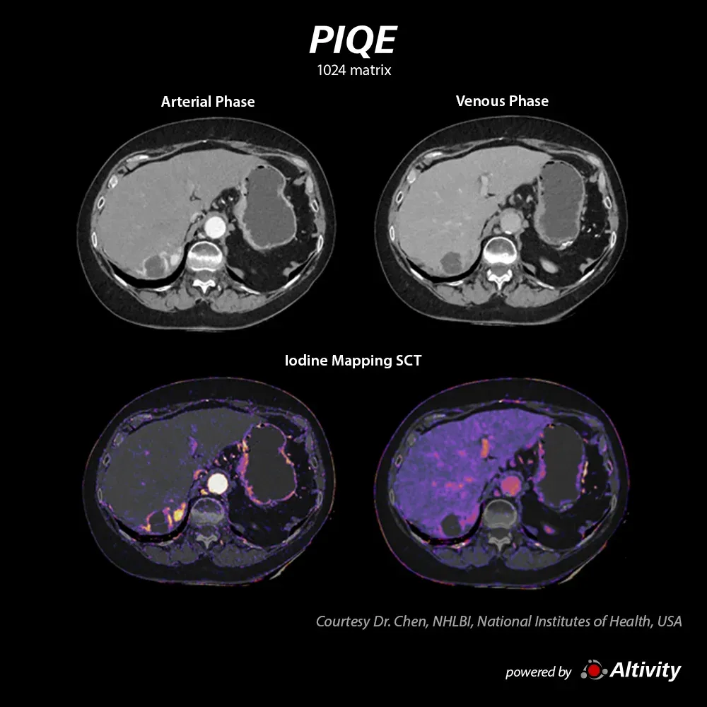 Leziune hepatică, hartă de iod SCT – Leziune hepatică evidențiată prin harta de iod SCT.