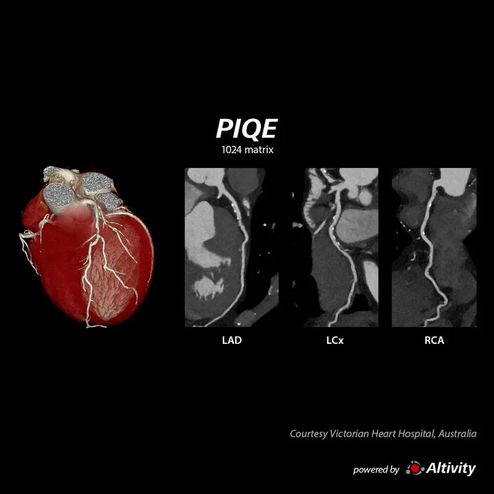 Angio-CT coronarian reconstruit cu PIQE 1024