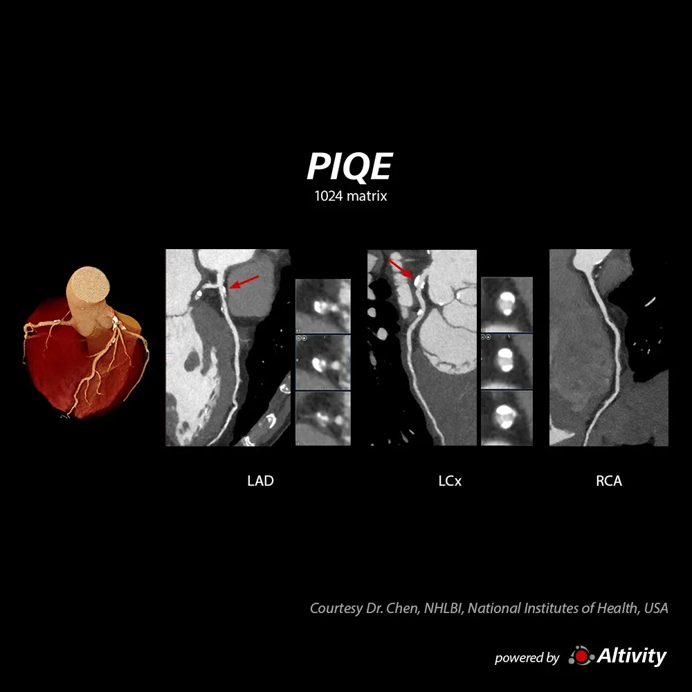 Placă, FC 62 bpm – Plăci calcificate evidențiate în această achiziție dintr-o singură bătaie cardiacă, reconstruită cu PIQE 1024.