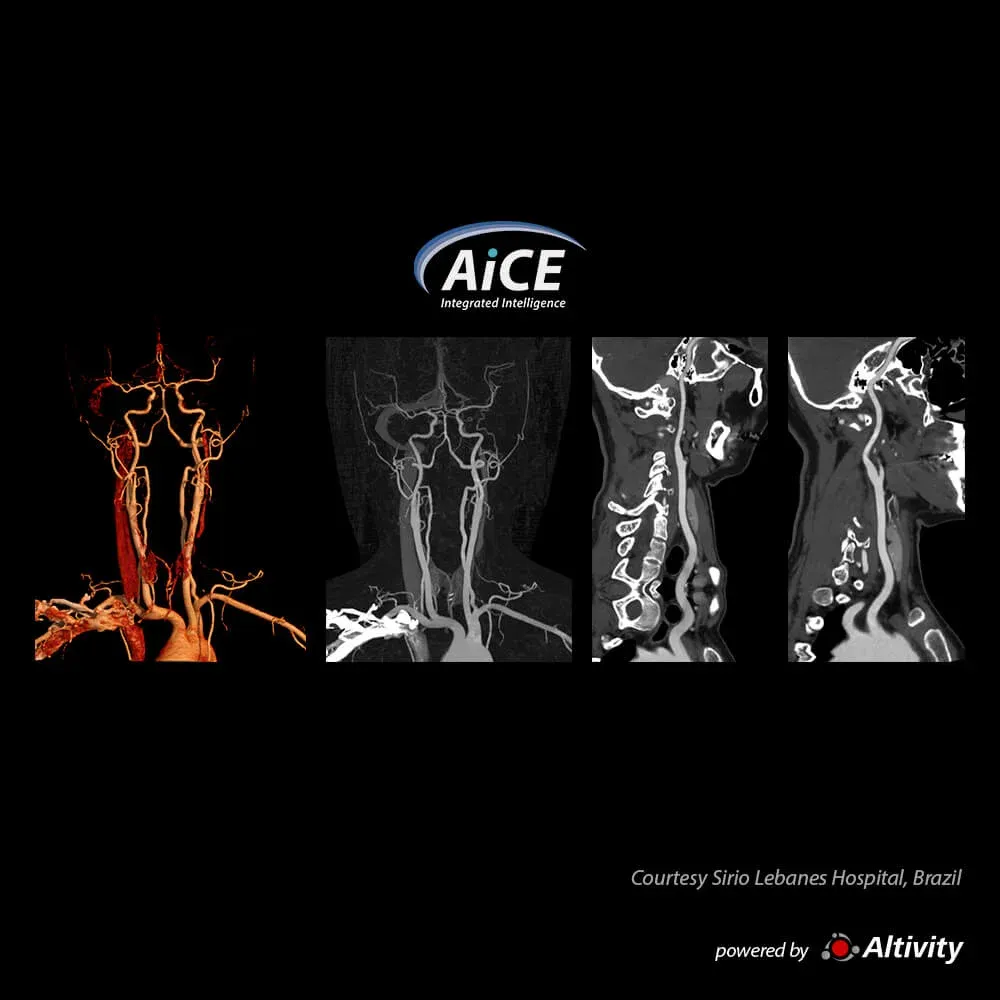 Angio-CT carotidiană cu SCT – Îndepărtarea complet automată a oaselor cu Angio SCT, salvată în protocolul de achiziție, oferă imagini excelente ale arterelor carotide, fără suprapunere osoasă.