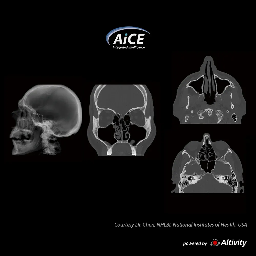 Sinusuri paranazale – Bărbat de 56 de ani cu sinuzită. Detalii osoase excelente cu reconstrucțiile AiCE Bone.