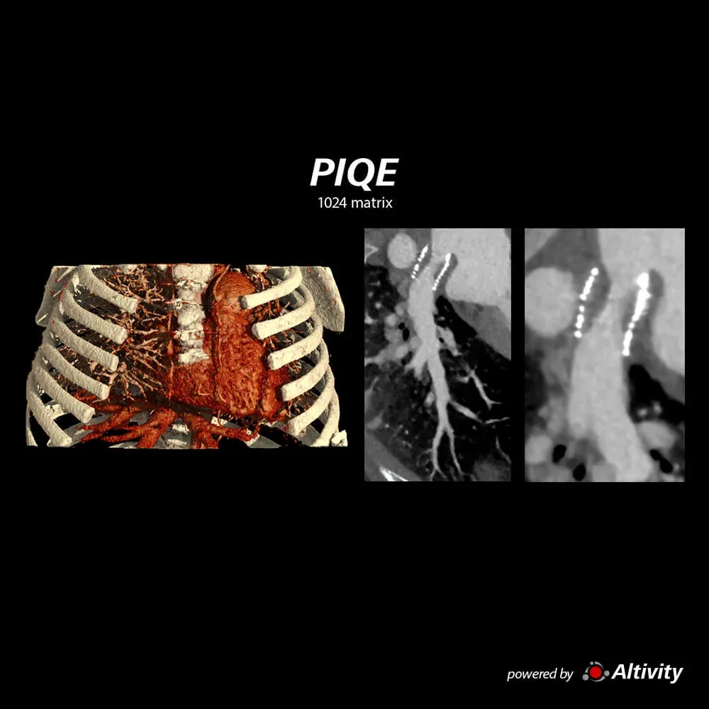 Cardiac, copil de 2 ani – Achiziție volumetrică cu sincronizare ECG la un copil de 2 ani, reconstruită cu PIQE 1024.