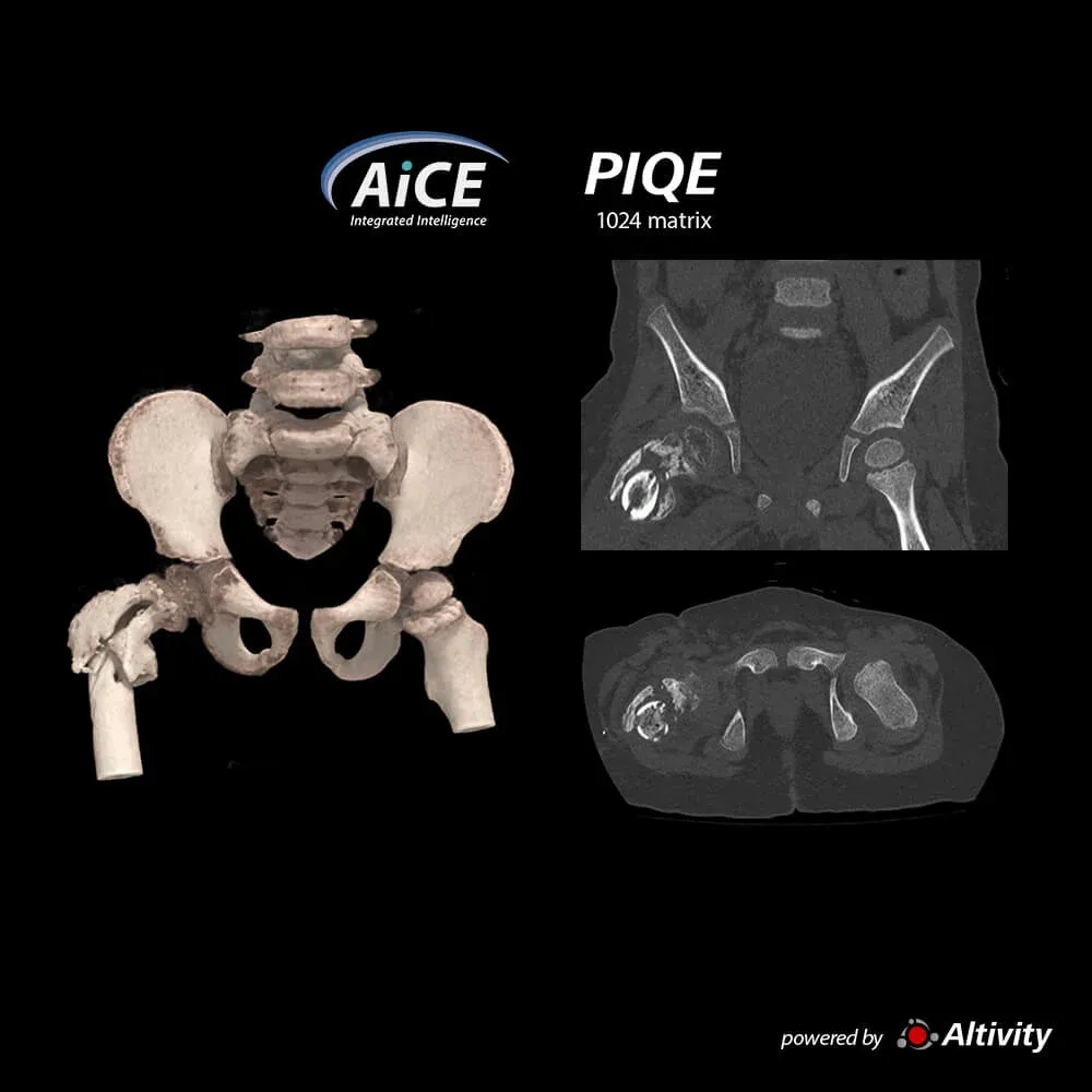 Fractură de femur proximal – O fractură de femur proximal este vizibilă în această achiziție volumetrică de 16 cm (0,5 mm x 320) a bazinului, la un copil de 2 ani.
