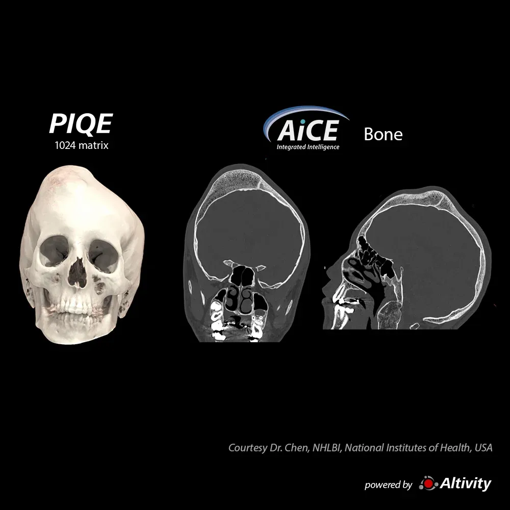 Craniu, pacient de 14 ani – Creștere anormală a craniului, vizibilă la acest pacient de 14 ani.