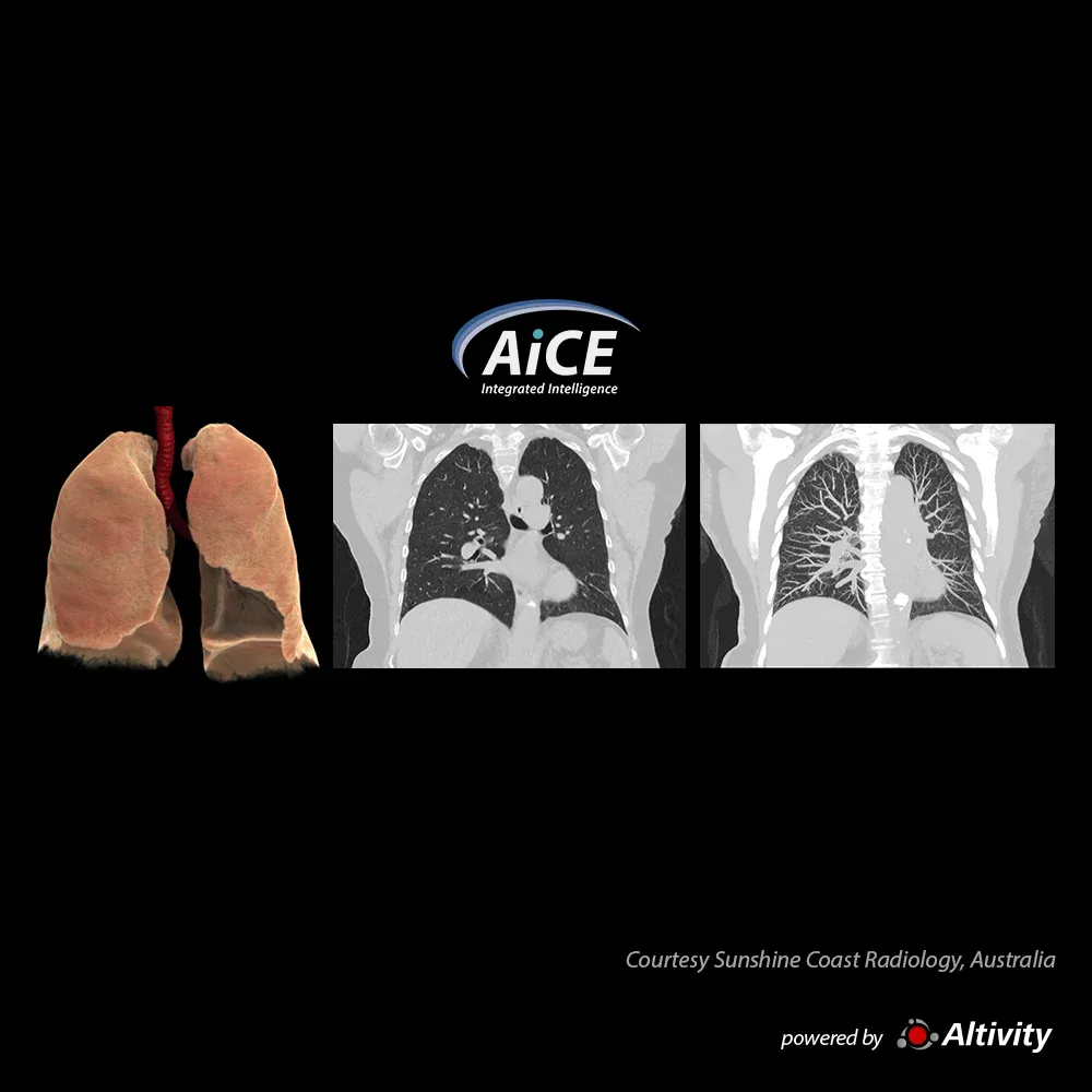 Torace SilverBeam – 0,4 mSv – Achiziție toracică cu doză redusă, efectuată cu SilverBeam pentru evaluarea nodulilor pulmonari. Imagine oferită de Sunshine Coast Radiology, Australia