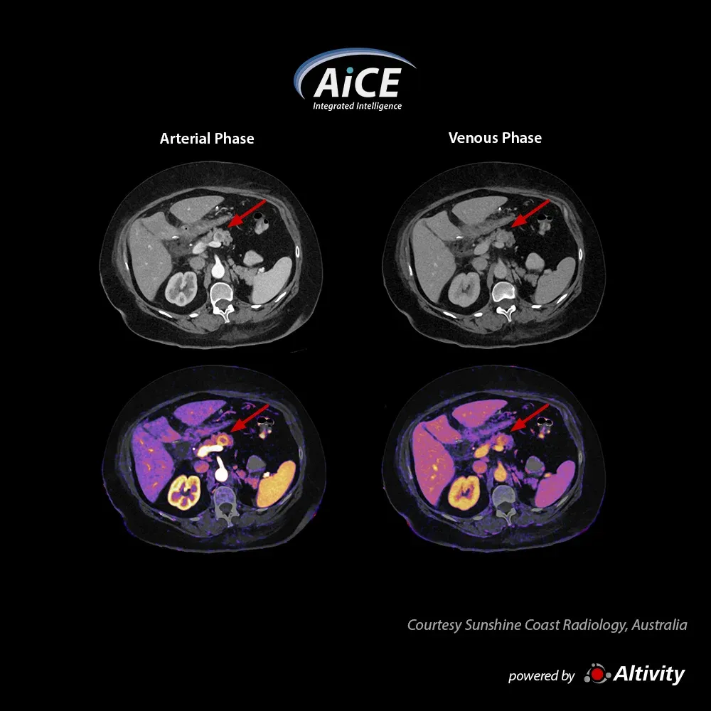 Abdomen cu hărți de iod – Leziune pancreatică vizibilă la această pacientă de 55 de ani, cu IMC 40. Imagine oferită de Sunshine Coast Radiology, Australia