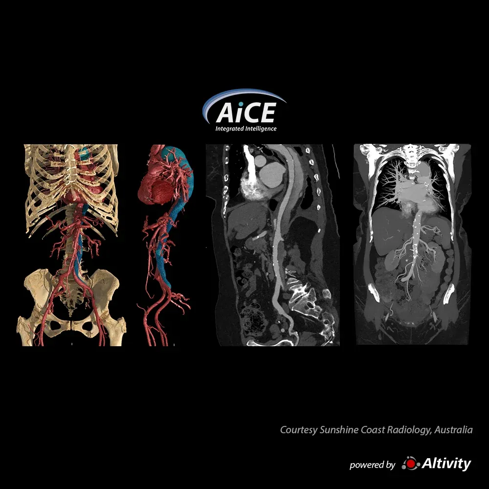 Angio-CT aortă – disecție – Disecție de tip B la o femeie de 75 de ani. Imagine oferită de Sunshine Coast Radiology, Australia