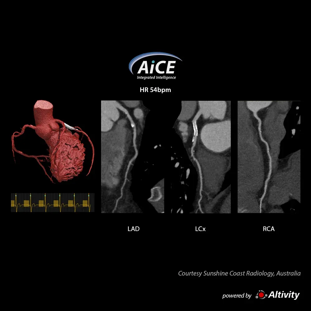 Cardiac – stent – Stent vizibil la nivelul LCx, la acest bărbat de 62 de ani, cu IMC 33. Imagine oferită de Sunshine Coast Radiology, Australia