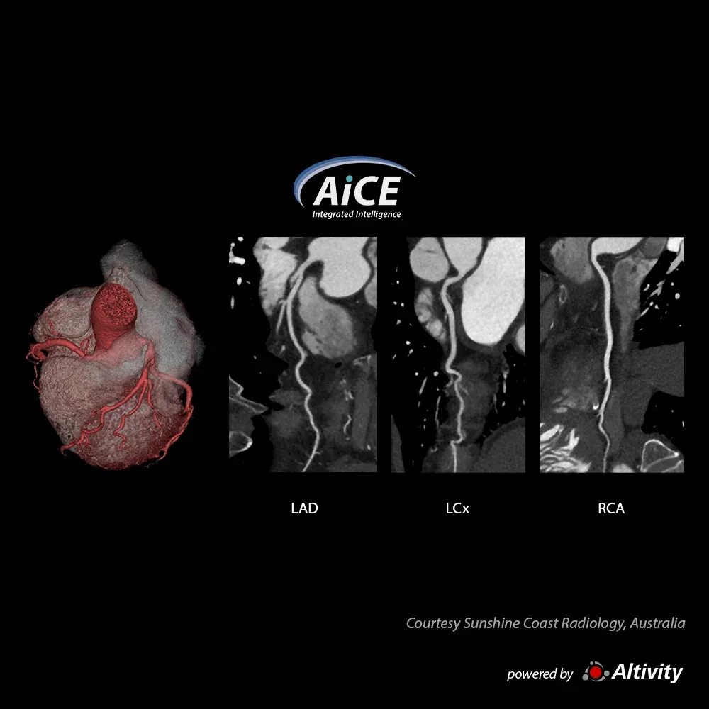 Cardiac 1,8 mSv – Angio-CT cardiacă la o femeie de 70 de ani, cu IMC 22 și durere toracică. Imagine oferită de Sunshine Coast Radiology, Australia