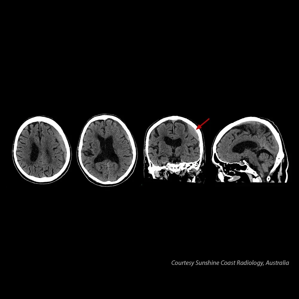 Creier – hematom subdural – Hematom subdural vizibil la acest pacient de 80 de ani. Imagine oferită de Sunshine Coast Radiology, Australia