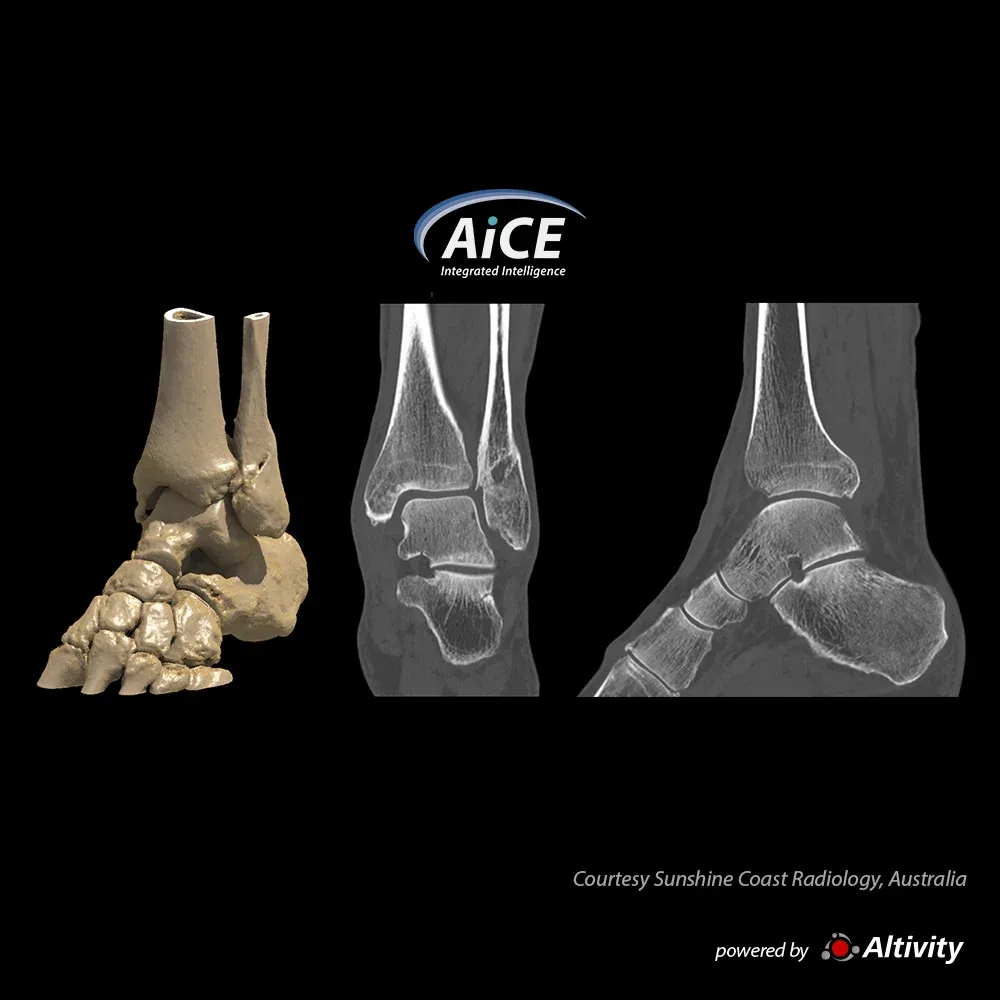 Gleznă – fractură – Control evolutiv al fracturii. Imagine oferită de Sunshine Coast Radiology, Australia