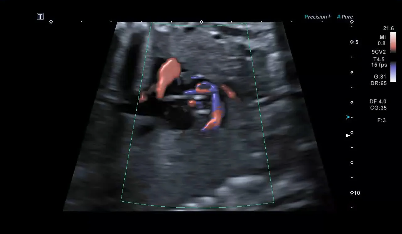 Exemplu clinic Doppler Luminance