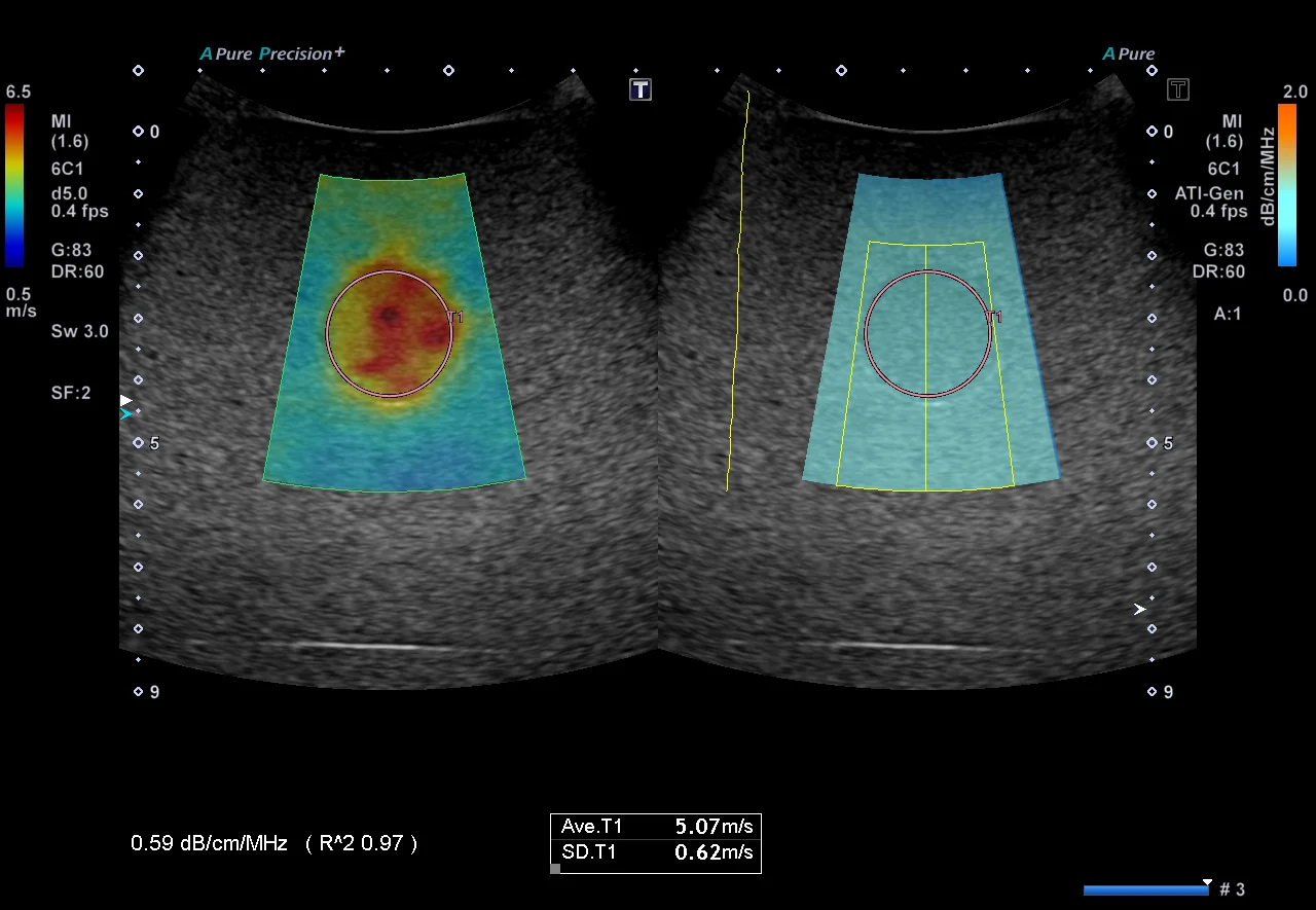 Attenuation Imaging pe platformele Aplio